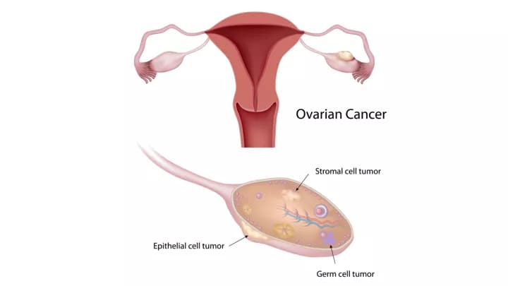 Threshold For Pre-Emptive Surgery To Curb Ovarian Cancer Risk Should Be Halved
