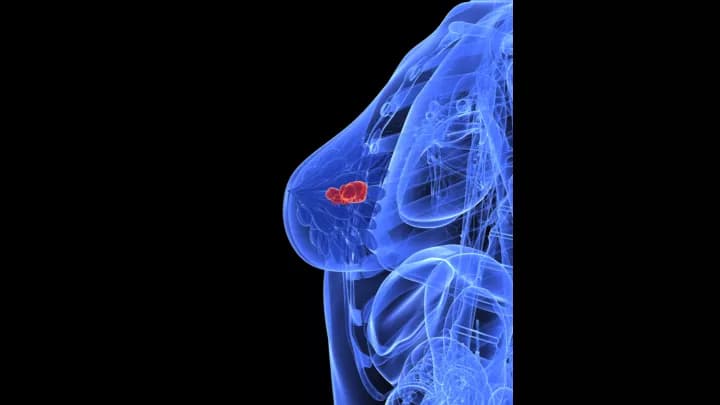Olaparib Slows Growth Of BRCA-Related Metastatic Breast Cancer