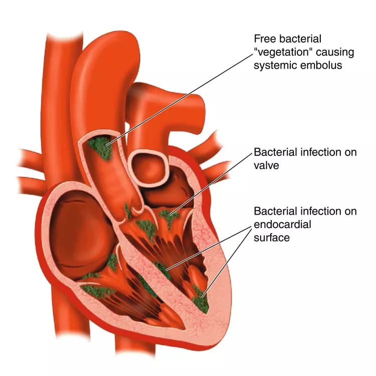 Risk Factors, Clinical Outcomes Of Infective Endocarditis After Transcatheter Aortic Valve Replacement