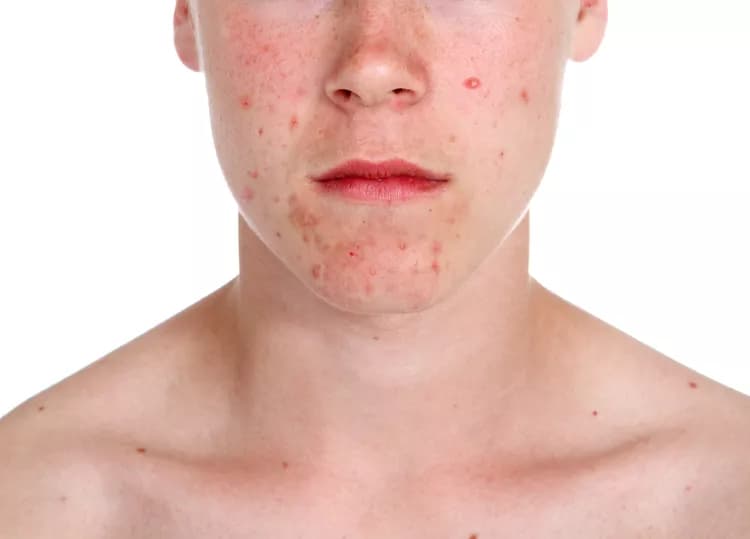 Facts about Acne