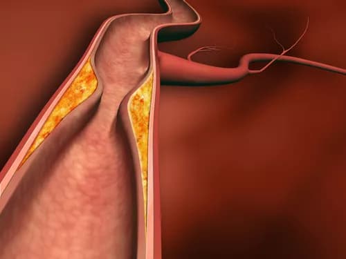 PCSK9 Inhibitor Improves Outcomes For Patients With Peripheral Artery Disease