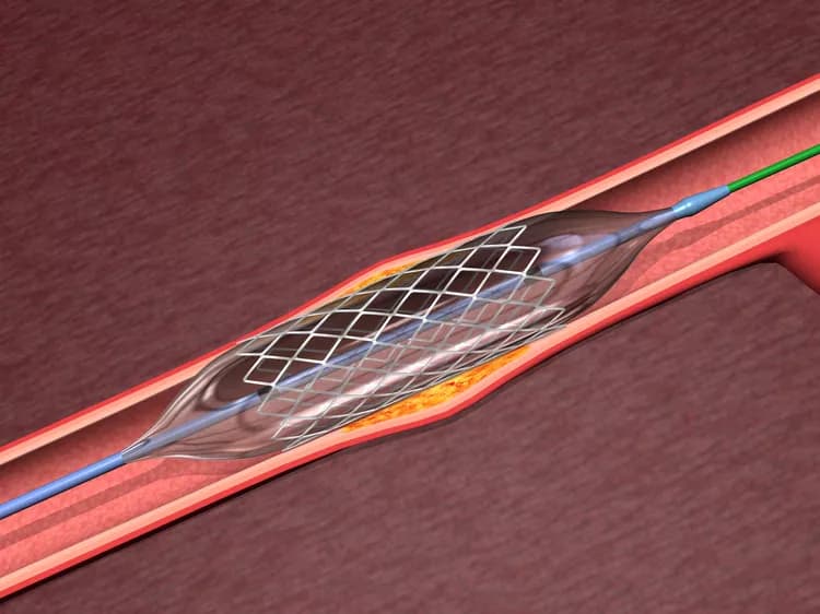 'Smart Stent' Detects Narrowing Of Arteries