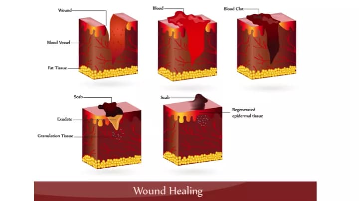 First Aid for Puncture Wounds