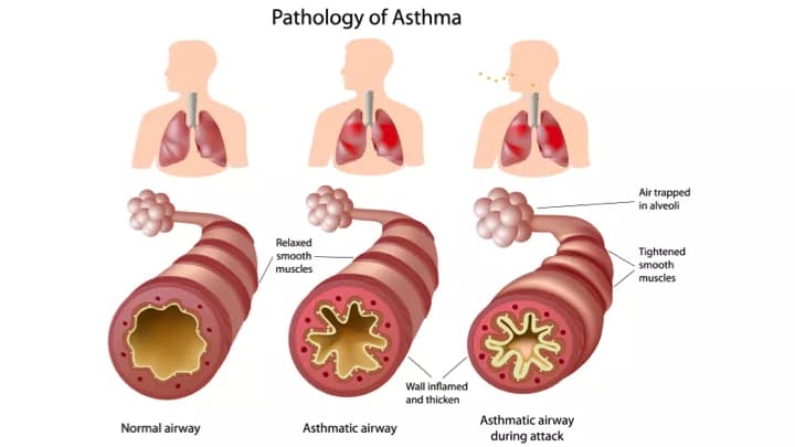 Facts about Asthma in Adults