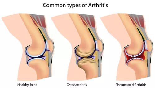 Facts about Arthritis of the Knee