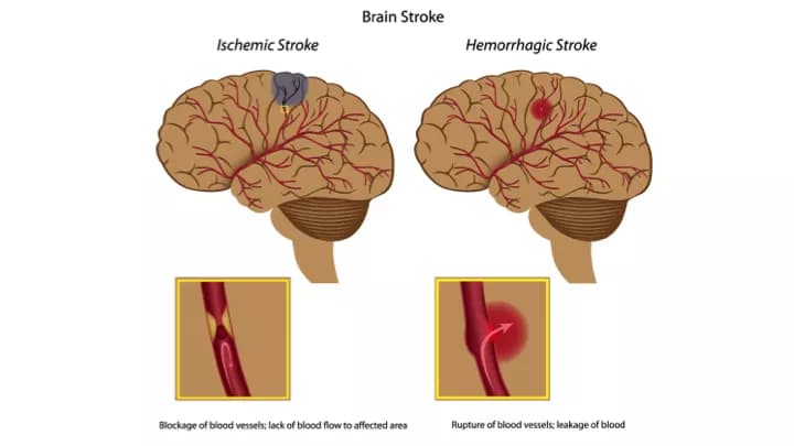 New Mindset In The Search For Stroke Therapies