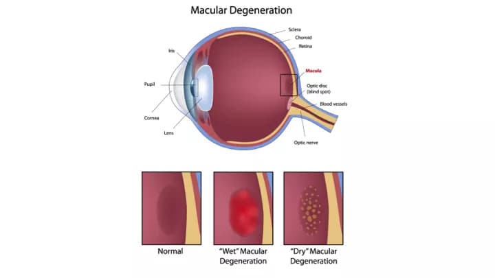 What is the best food to eat for those at risk for Macular Degeneration?