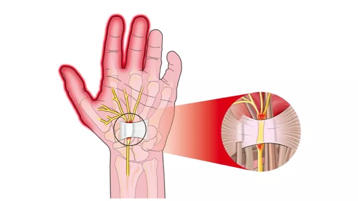 Facts about Carpal Tunnel Syndrome
