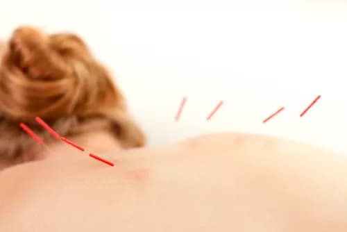 Benefits Of Acupuncture: Fact Or Myth?