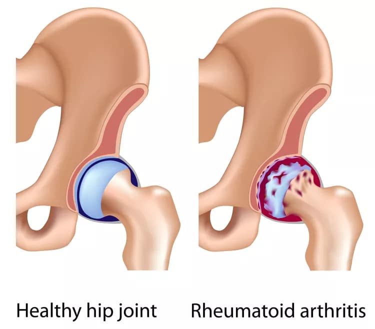 Rheumatoid Arthritis Linked To Increased Risk Of Death