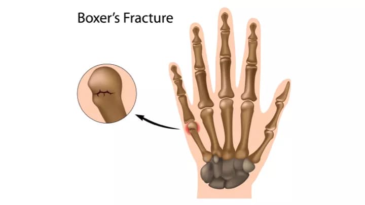 Hand Fracture