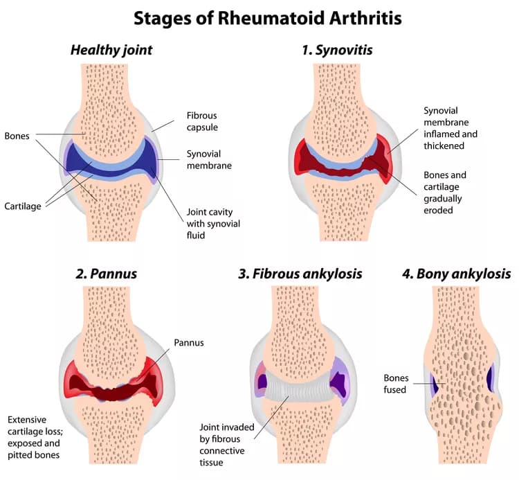 How well do you know Rheumatoid Arthritis (RA)