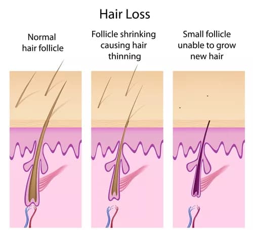 Increased Risk Of Uterine Fibroids In African-american Women With A Common Form Of Hair Loss