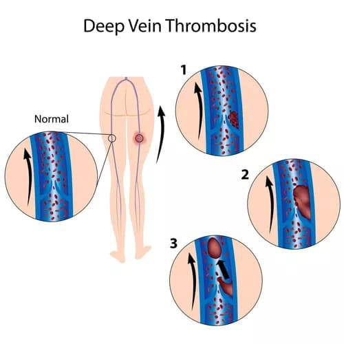 Facts about Deep Vein Thrombosis