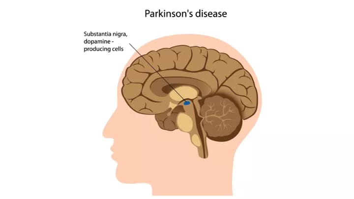 Parkinson's Severity Assessed Through Drawing