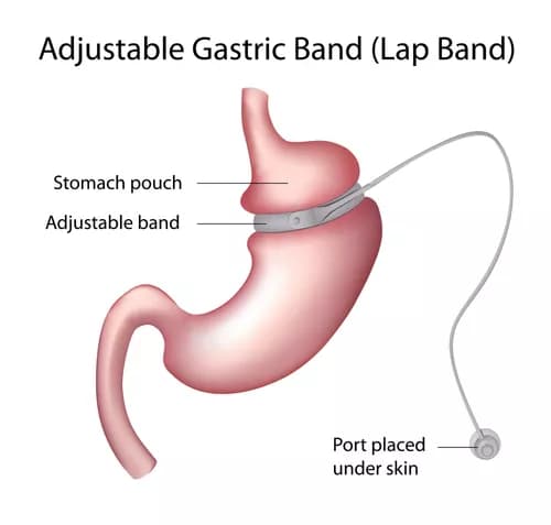 Weight Loss Surgery Linked To Gastrointestinal Complaints