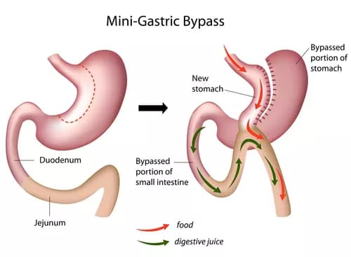 Gastric Bypass Helps Severely Obese Teenagers Maintain Weight Loss Over Long Term