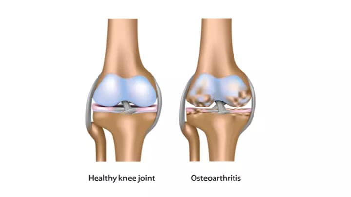 Osteoarthritis of the Knee - DoveMed Osteoarthritis of the Knee - DoveMed