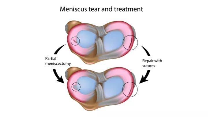 Meniscectomy