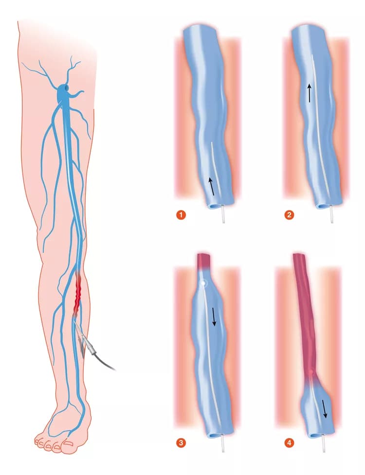 Endovenous Ablation of Varicose Veins